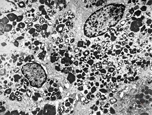 M,58y. | crystalline inclusions in hepatocyte after unknown medication